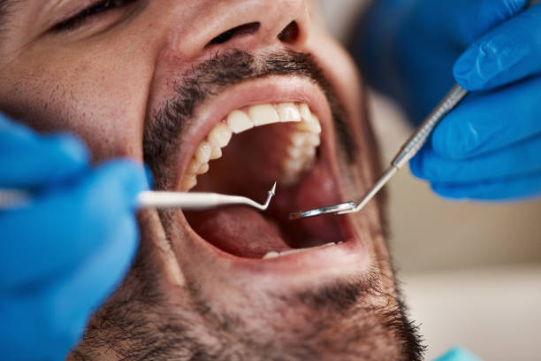 Best Emergency Gum Treatment in King City, CA